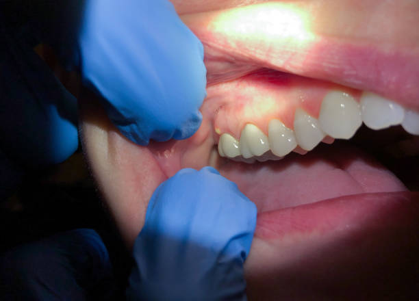 Best Emergency Tooth Extraction in Selma, TX